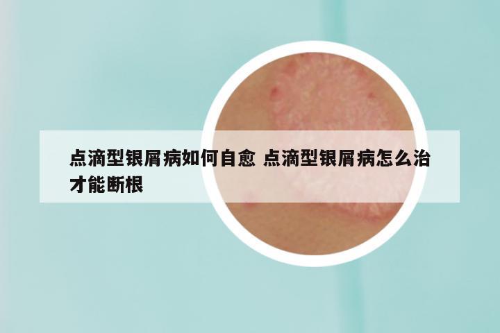 点滴型银屑病如何自愈 点滴型银屑病怎么治才能断根