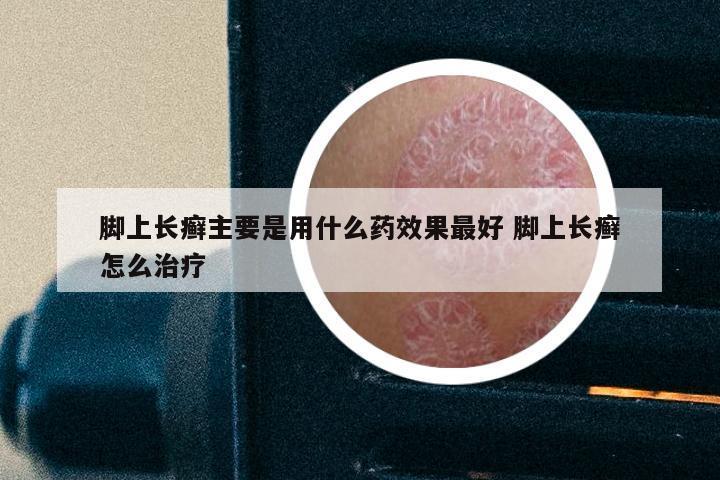 脚上长癣主要是用什么药效果最好 脚上长癣怎么治疗