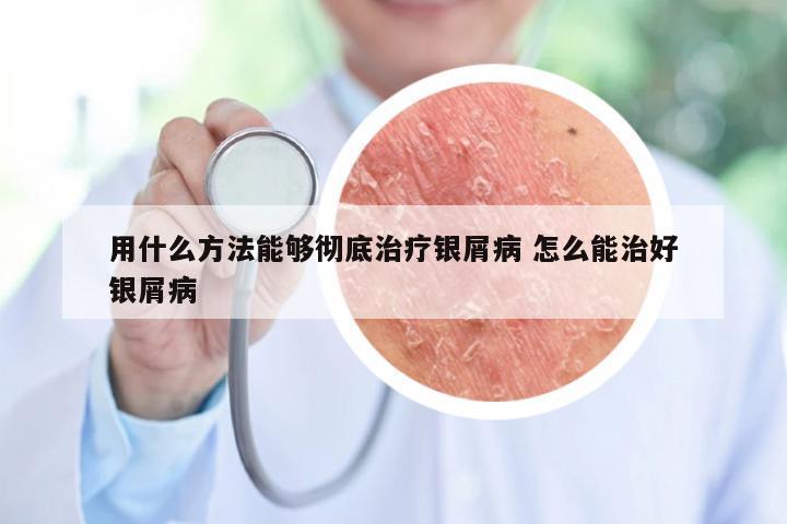 用什么方法能够彻底治疗银屑病 怎么能治好银屑病