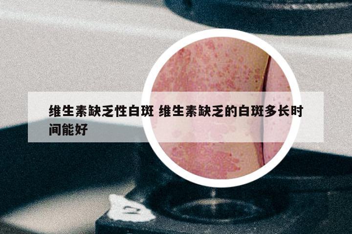 维生素缺乏性白斑 维生素缺乏的白斑多长时间能好