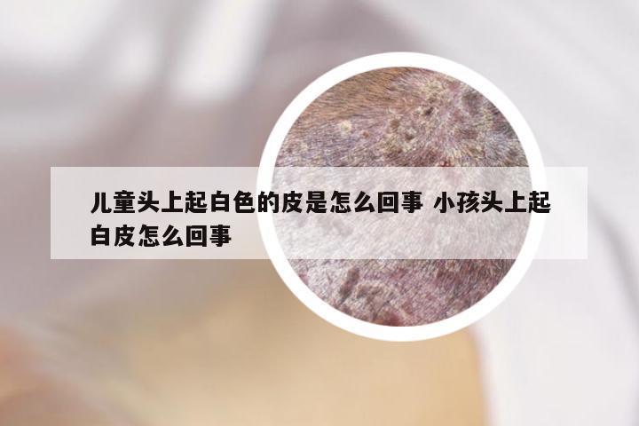 儿童头上起白色的皮是怎么回事 小孩头上起白皮怎么回事