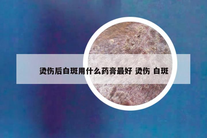 烫伤后白斑用什么药膏最好 烫伤 白斑