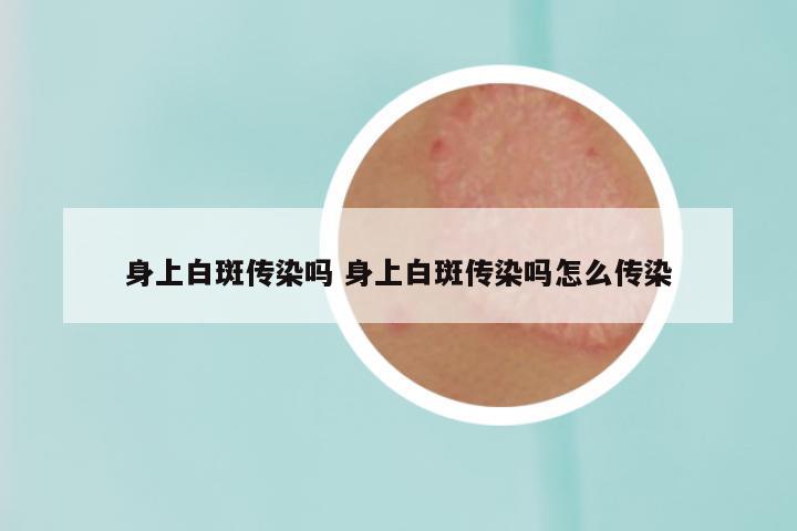 身上白斑传染吗 身上白斑传染吗怎么传染