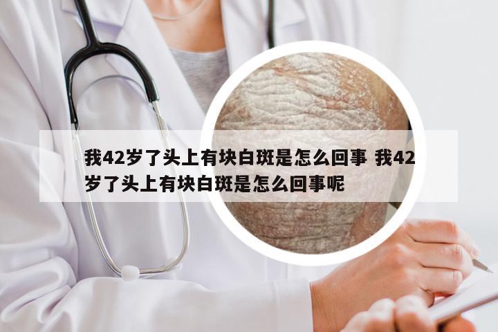 我42岁了头上有块白斑是怎么回事 我42岁了头上有块白斑是怎么回事呢