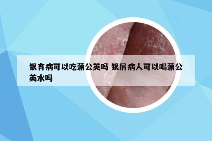 银宵病可以吃蒲公英吗 银屑病人可以喝蒲公英水吗