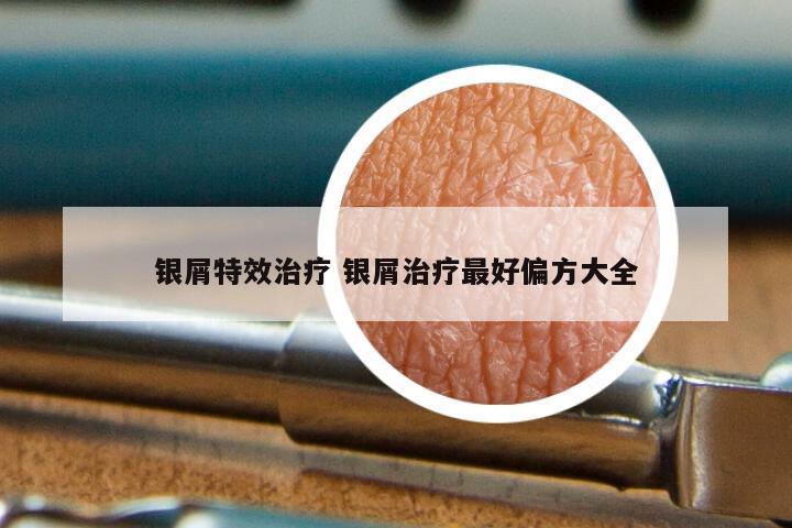 银屑特效治疗 银屑治疗最好偏方大全