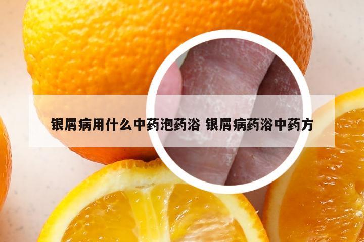 银屑病用什么中药泡药浴 银屑病药浴中药方