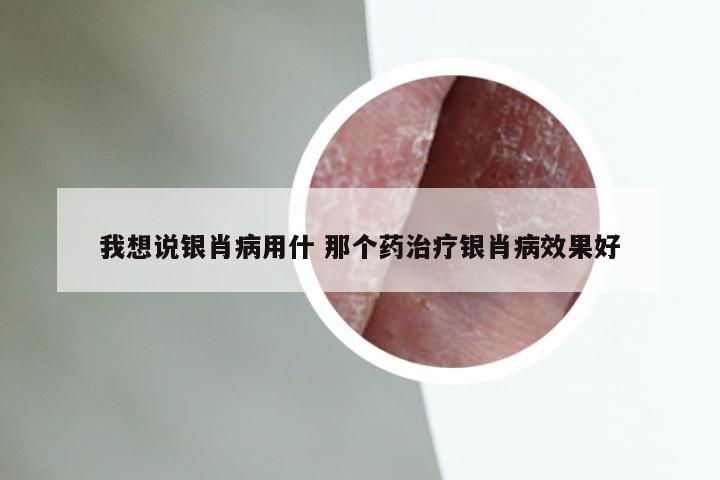 我想说银肖病用什 那个药治疗银肖病效果好