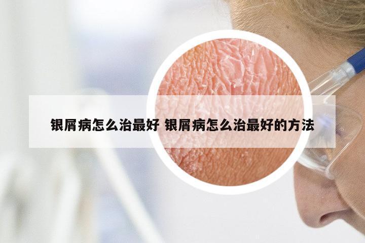 银屑病怎么治最好 银屑病怎么治最好的方法