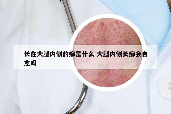 长在大腿内侧的癣是什么 大腿内侧长癣会自愈吗