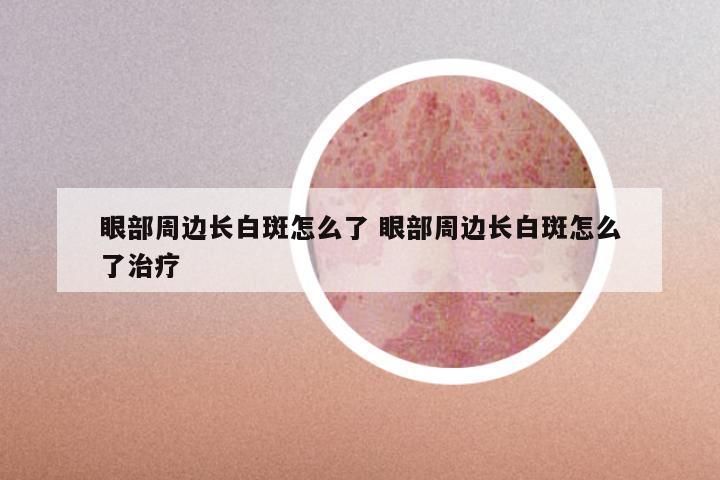 眼部周边长白斑怎么了 眼部周边长白斑怎么了治疗