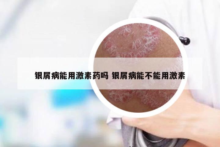 银屑病能用激素药吗 银屑病能不能用激素