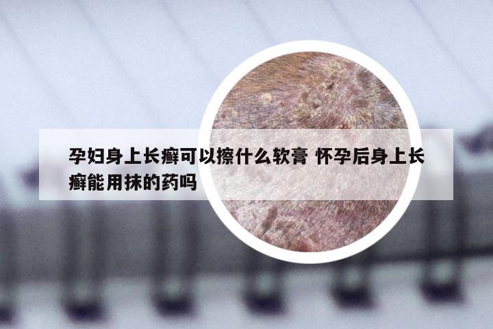 孕妇身上长癣可以擦什么软膏 怀孕后身上长癣能用抹的药吗