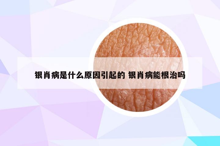 银肖病是什么原因引起的 银肖病能根治吗