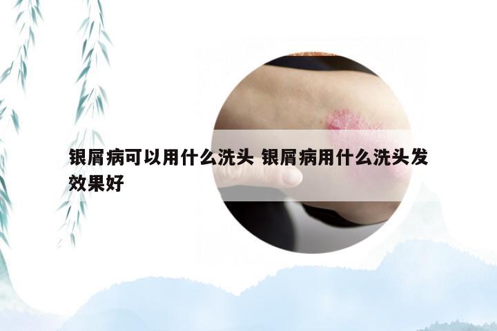 银屑病可以用什么洗头 银屑病用什么洗头发效果好