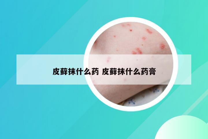 皮藓抹什么药 皮藓抹什么药膏