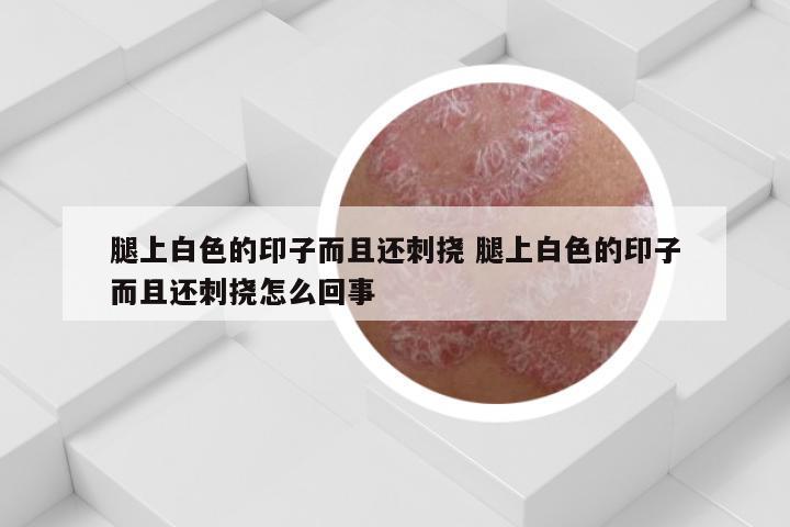 腿上白色的印子而且还刺挠 腿上白色的印子而且还刺挠怎么回事