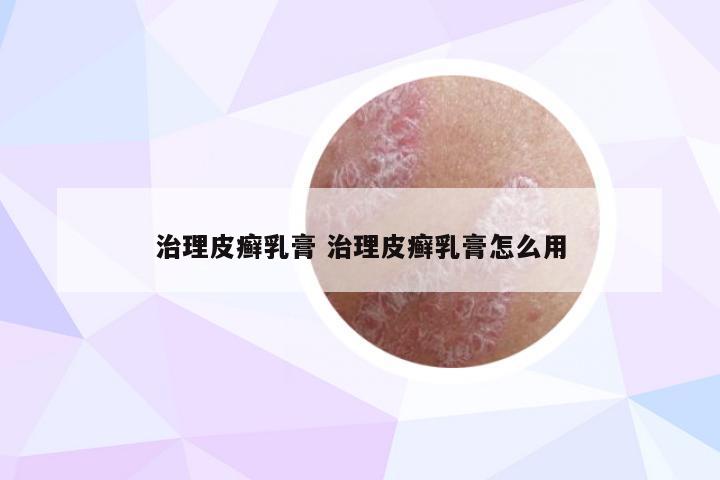 治理皮癣乳膏 治理皮癣乳膏怎么用