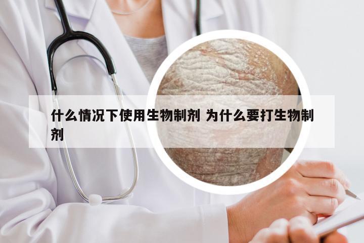 什么情况下使用生物制剂 为什么要打生物制剂