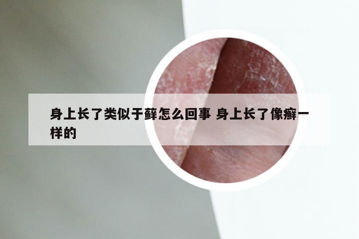 身上长了类似于藓怎么回事 身上长了像癣一样的