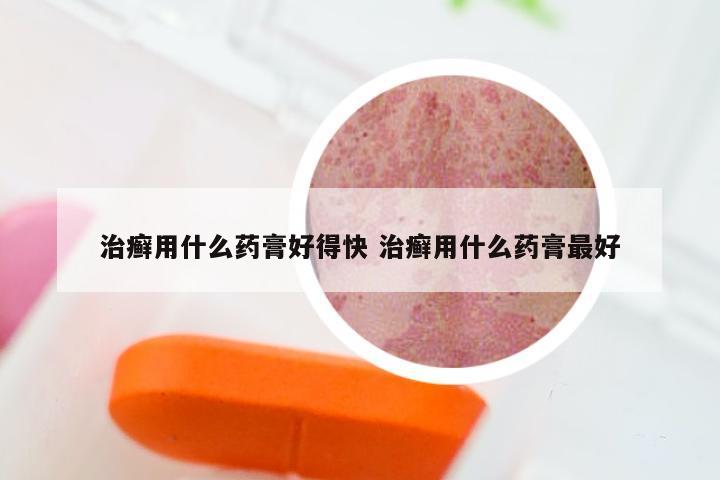 治癣用什么药膏好得快 治癣用什么药膏最好