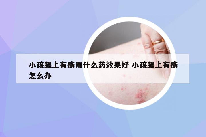 小孩腿上有癣用什么药效果好 小孩腿上有癣怎么办