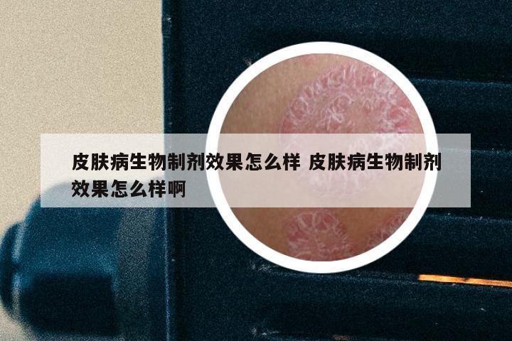 皮肤病生物制剂效果怎么样 皮肤病生物制剂效果怎么样啊