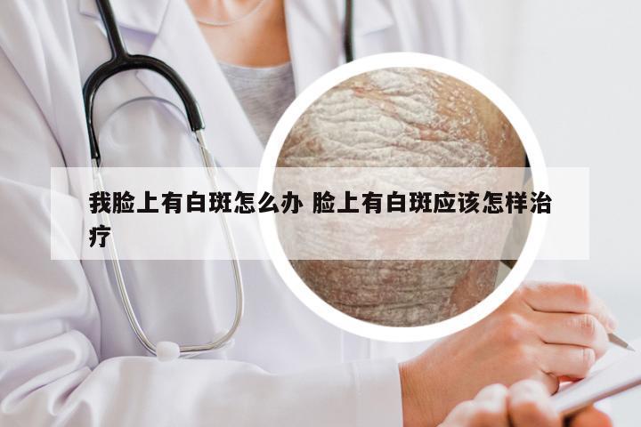 我脸上有白斑怎么办 脸上有白斑应该怎样治疗