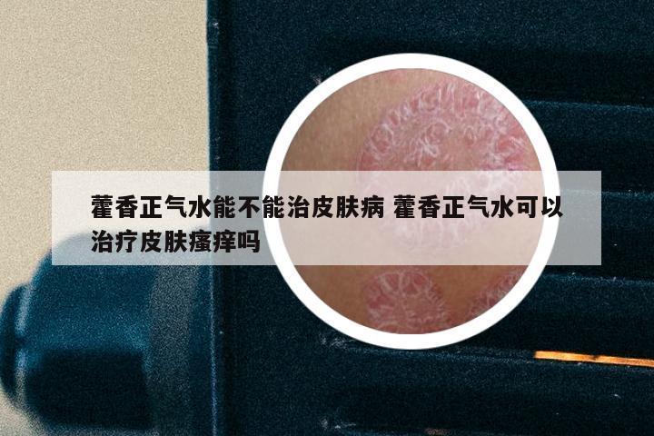 藿香正气水能不能治皮肤病 藿香正气水可以治疗皮肤瘙痒吗