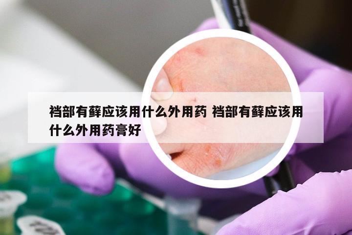 裆部有藓应该用什么外用药 裆部有藓应该用什么外用药膏好