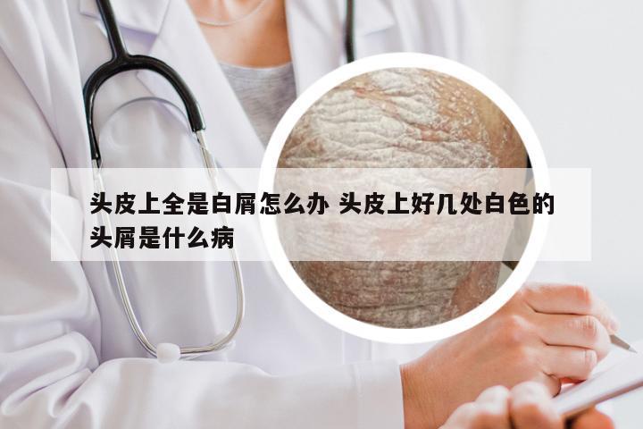 头皮上全是白屑怎么办 头皮上好几处白色的头屑是什么病