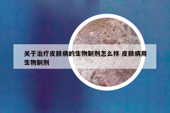 关于治疗皮肤病的生物制剂怎么样 皮肤病用生物制剂