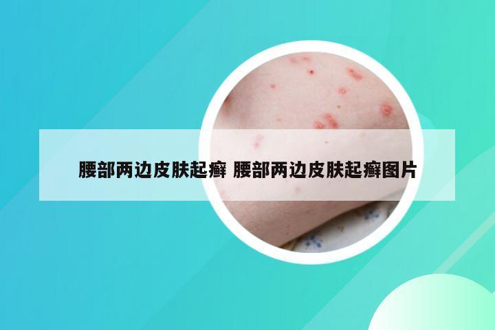 腰部两边皮肤起癣 腰部两边皮肤起癣图片