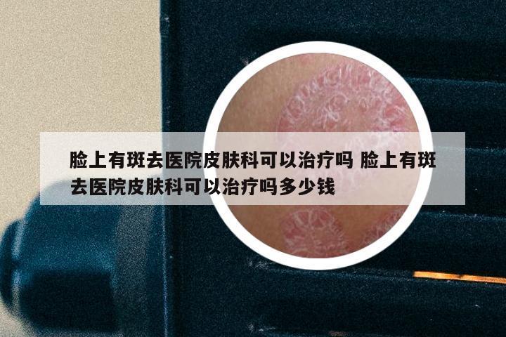 脸上有斑去医院皮肤科可以治疗吗 脸上有斑去医院皮肤科可以治疗吗多少钱