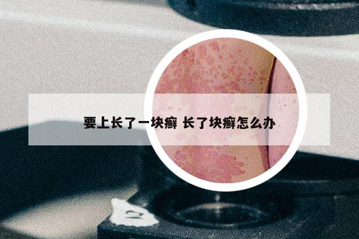 要上长了一块癣 长了块癣怎么办