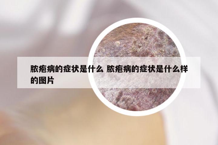 脓疱病的症状是什么 脓疱病的症状是什么样的图片