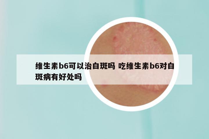 维生素b6可以治白斑吗 吃维生素b6对白斑病有好处吗