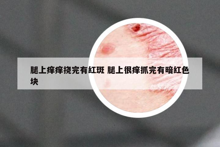 腿上痒痒挠完有红斑 腿上很痒抓完有暗红色块