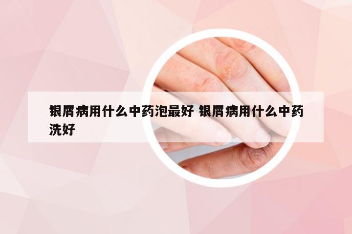 银屑病用什么中药泡最好 银屑病用什么中药洗好