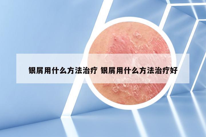 银屑用什么方法治疗 银屑用什么方法治疗好