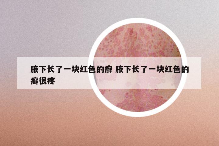 腋下长了一块红色的癣 腋下长了一块红色的癣很疼