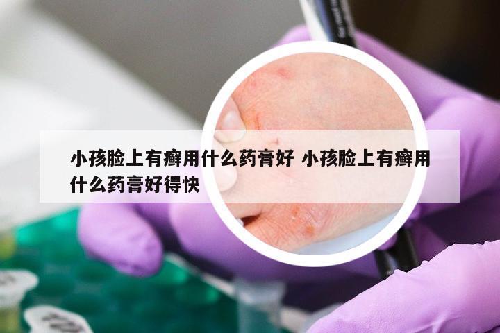 小孩脸上有癣用什么药膏好 小孩脸上有癣用什么药膏好得快