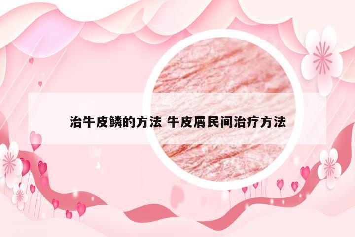 治牛皮鳞的方法 牛皮屑民间治疗方法