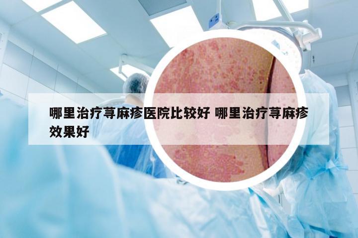 哪里治疗荨麻疹医院比较好 哪里治疗荨麻疹效果好