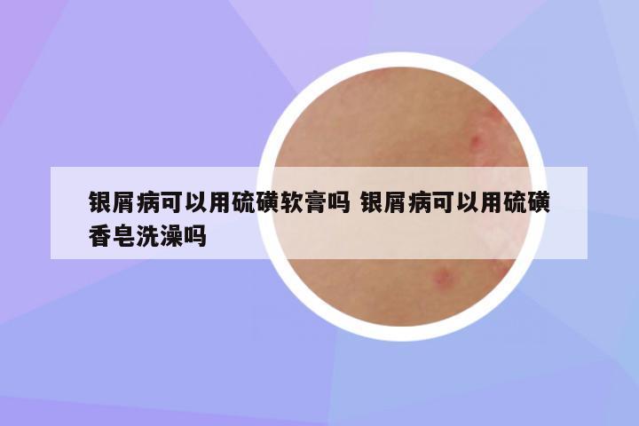 银屑病可以用硫磺软膏吗 银屑病可以用硫磺香皂洗澡吗