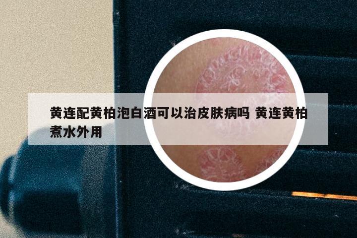 黄连配黄柏泡白酒可以治皮肤病吗 黄连黄柏煮水外用