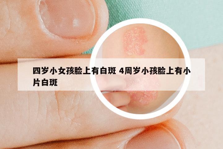 四岁小女孩脸上有白斑 4周岁小孩脸上有小片白斑