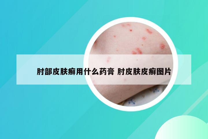 肘部皮肤癣用什么药膏 肘皮肤皮癣图片