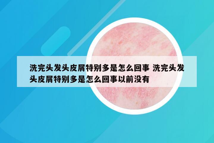 洗完头发头皮屑特别多是怎么回事 洗完头发头皮屑特别多是怎么回事以前没有