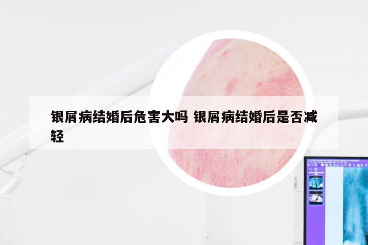 银屑病结婚后危害大吗 银屑病结婚后是否减轻